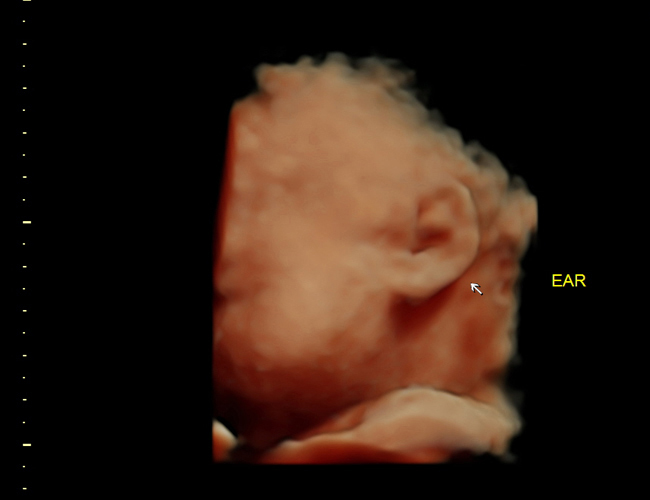 3D ultrasound image at 31 weeks